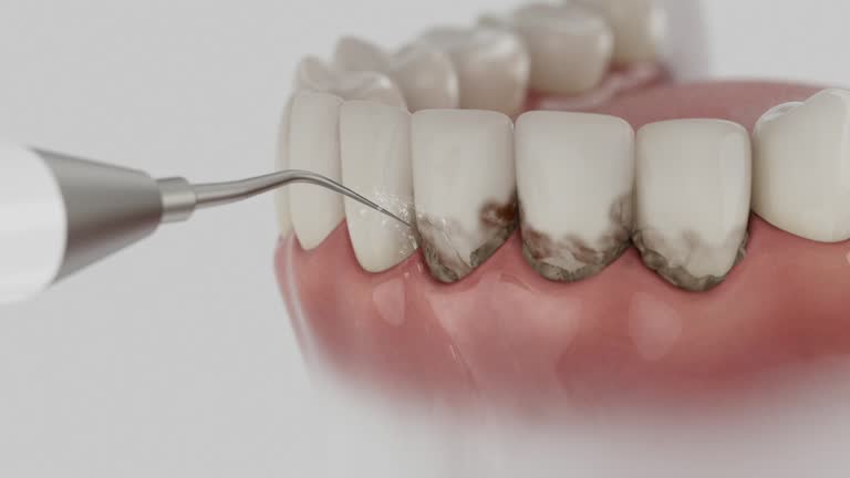 Trusted Wisdom Tooth Removal service in Moundsville, WV - Dentist Open Now